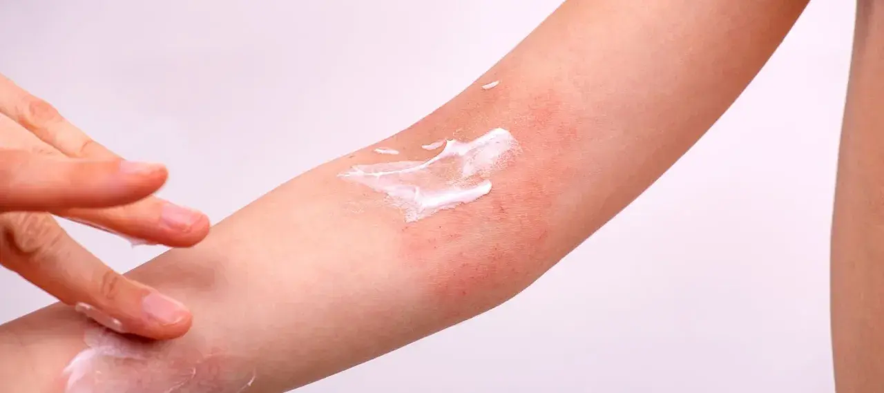 Application de crème sur une plaque sèche et rouge sur le bras, soulageant l'irritation cutanée.