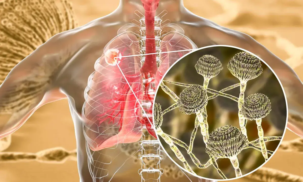 Ingrandimento di Aspergillus fumigatus che infetta i polmoni umani.