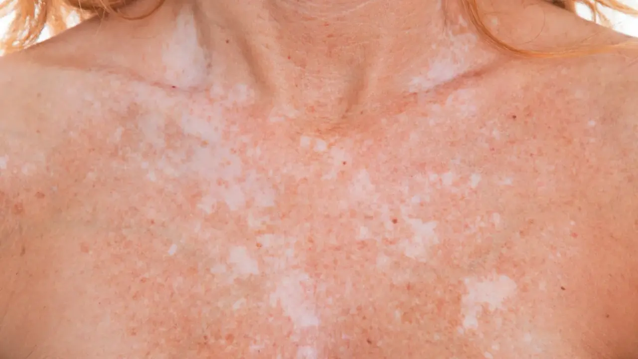 Poitrine et cou d'une personne présentant une dépigmentation de la peau, avec des taches claires et foncées.