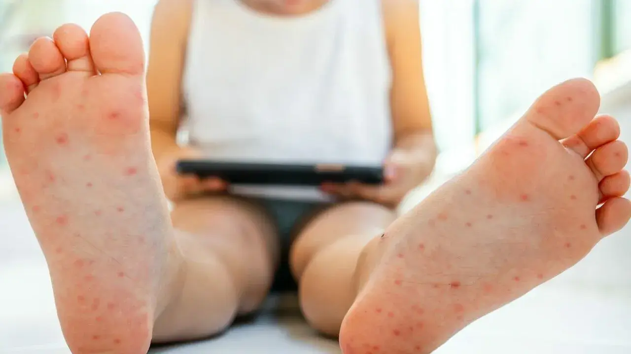 Małe czerwone kropki na stopach dziecka, które mogą wskazywać na wysypkę. Dziecko siedzi, trzymając tablet.