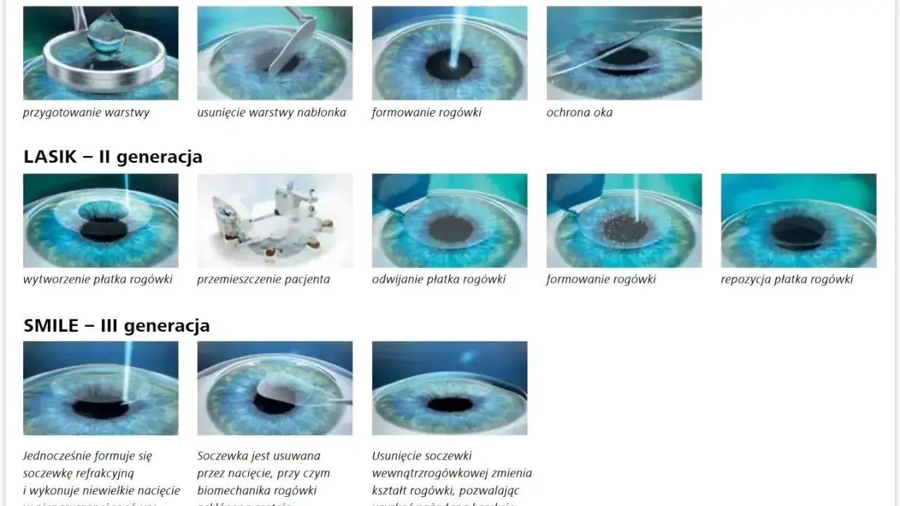 Ilustracje pokazują etapy leczenia astygmatyzmu metodami PRK, LASIK i SMILE.