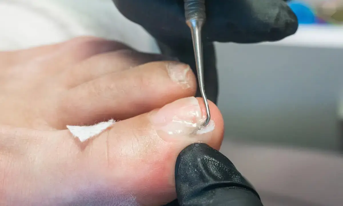Prise en charge podologue diabète : un professionnel utilise un instrument pour nettoyer délicatement un ongle de pied, assurant des soins essentiels.