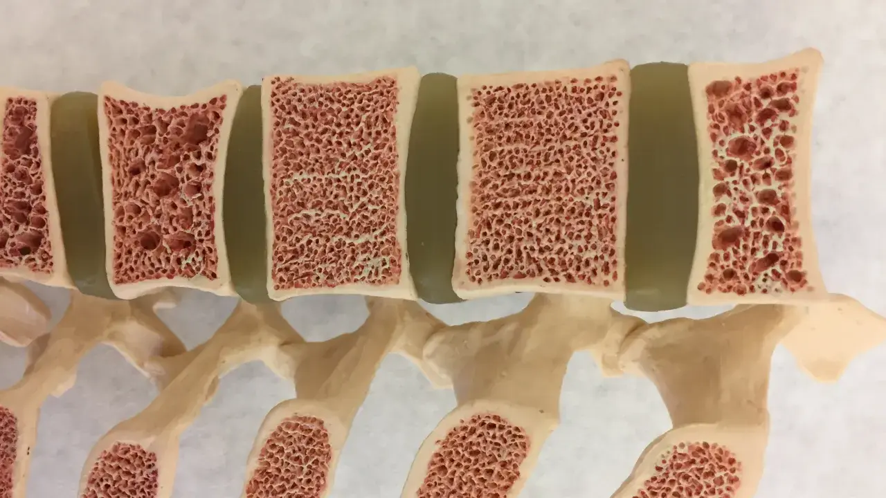 Model kręgosłupa z widocznymi przekrojami kości, ukazujący ich gąbczastą strukturę. Może to być przykład osteoporozy w młodym wieku.