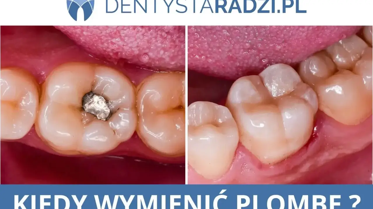 Porównanie zęba z amalgamatową plombą i zęba po wymianie na nową, estetyczną plombę. Kiedy wymienić plombę?