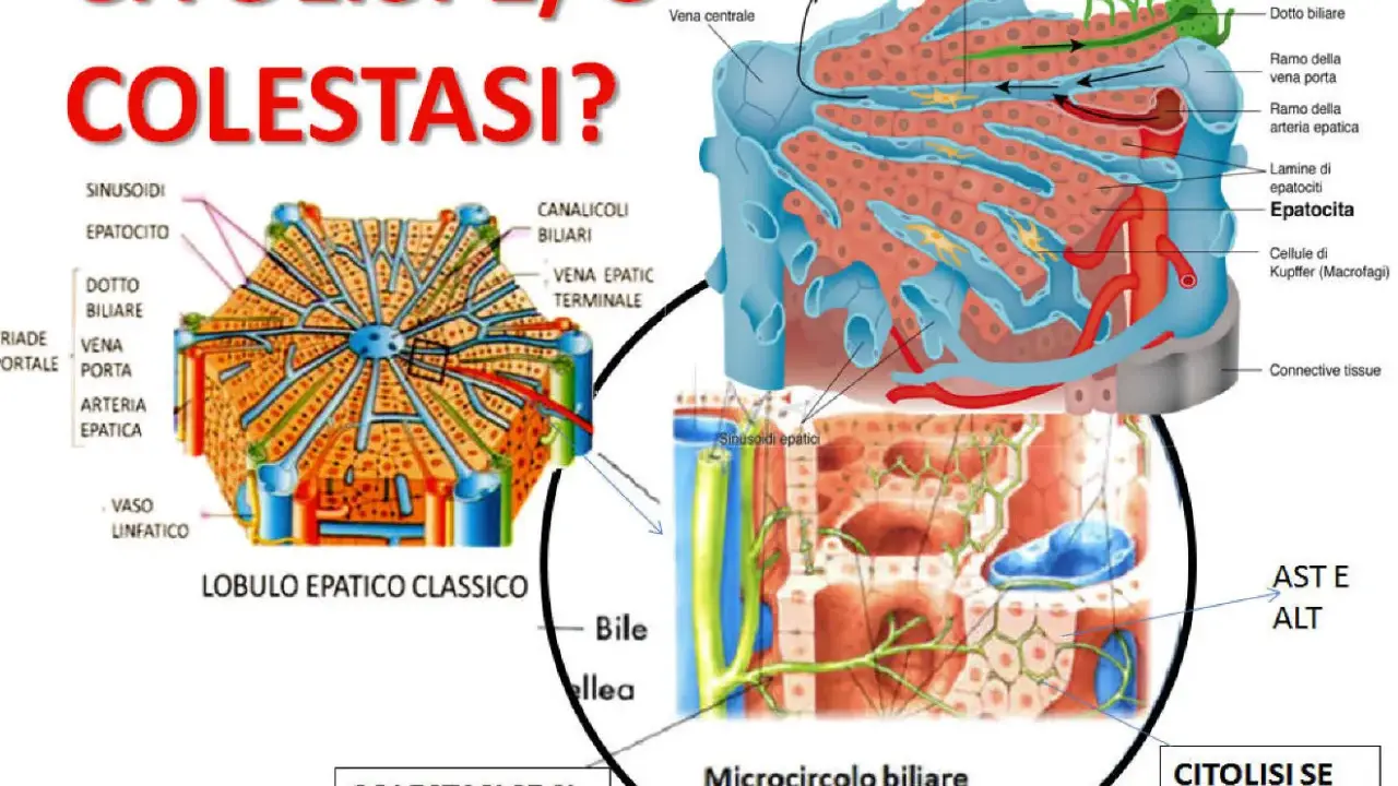 Diagrammi illustrano lobulo epatico e acino epatico, con focus su citolisi e colestasi, evidenziando epatociti e microcircolo biliare.