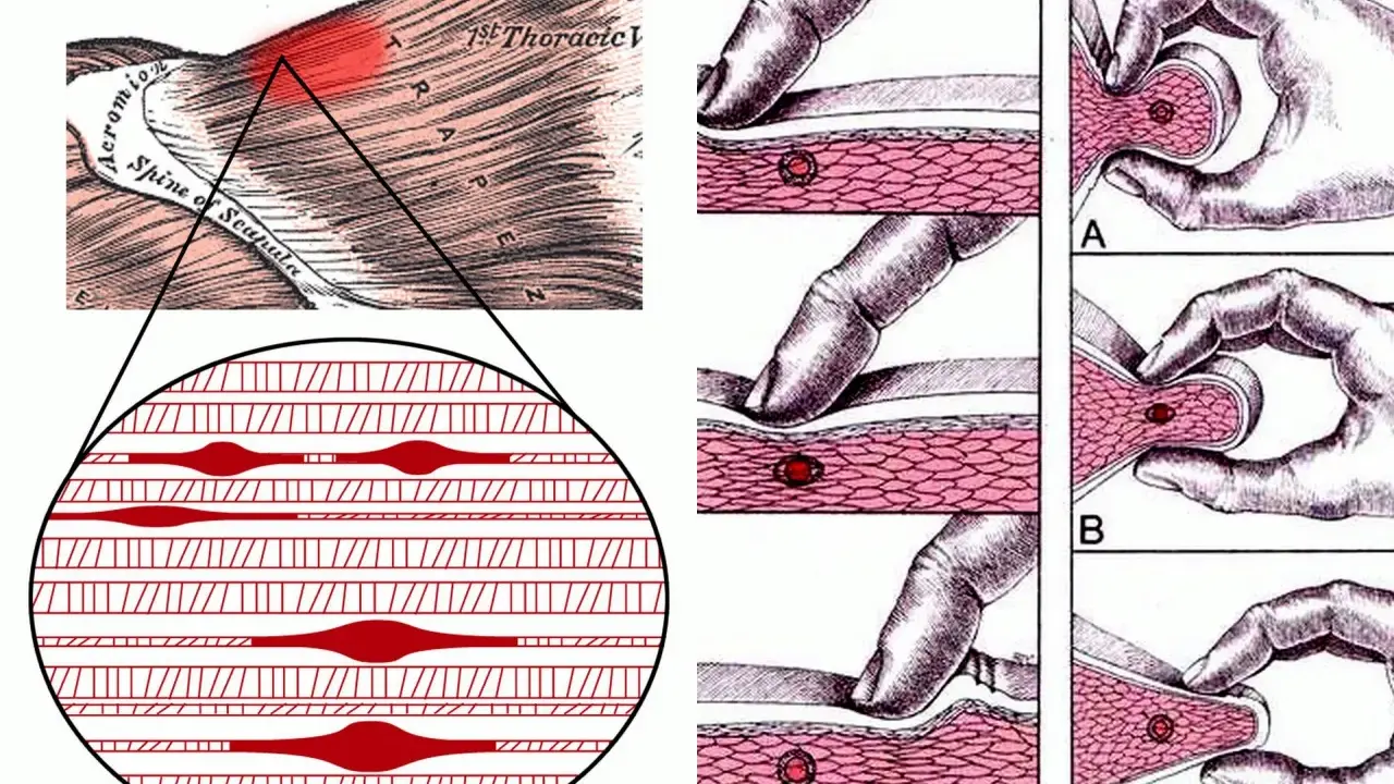 Ilustracja pokazuje punkty spustowe w mięśniach, ich lokalizację na ramieniu i metody palpacji.