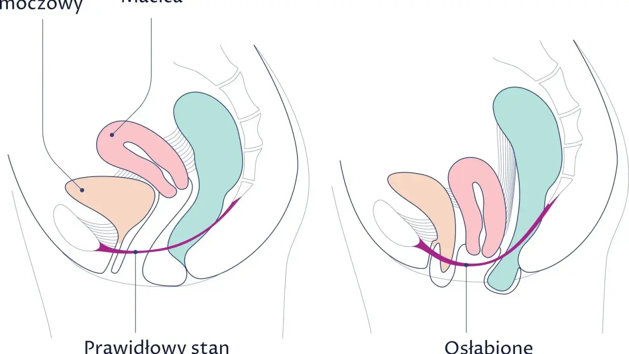 Ilustracja porównuje prawidłowy i osłabiony stan dna miednicy. Wypadająca macica objawy mogą być widoczne przy osłabieniu mięśni.