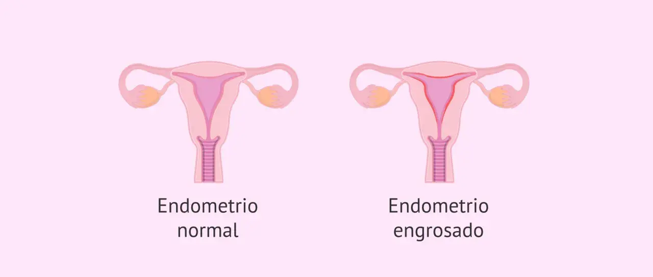 Comparación visual de un útero con endometrio normal y otro con endometrio engrosado, indicativo de hiperplasia endometrial.