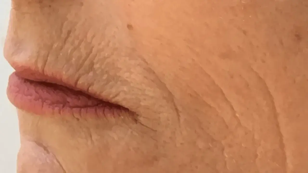 Nahaufnahme der Lippen und der Haut einer älteren Person mit tiefen Falten, die auf die Auswirkungen des Rauchens hinweisen. Kleine Pickel sind sichtbar.