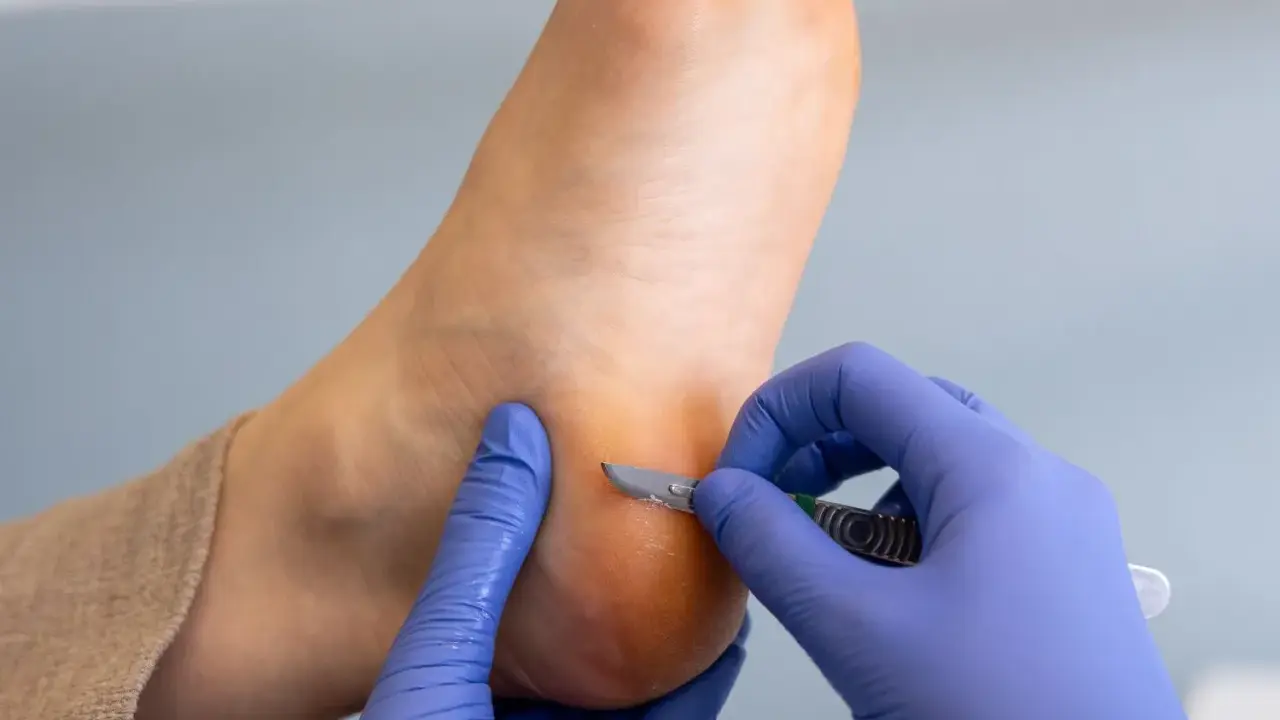 Un podologue enlève une callosité au pied avec un scalpel.