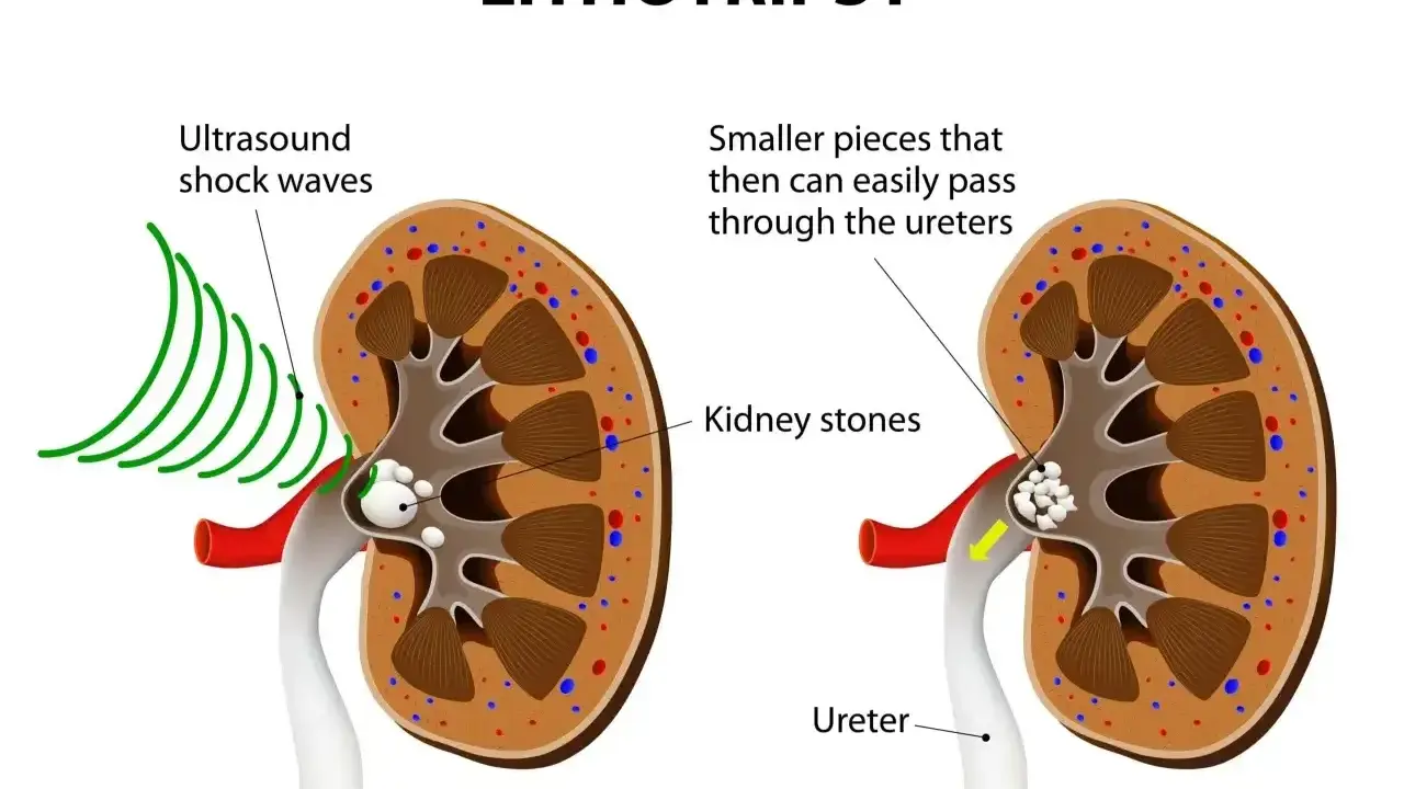 Litotrypsja w urologii: fale ultradźwiękowe rozbijają kamienie nerkowe na mniejsze fragmenty, które łatwiej przechodzą przez moczowód.