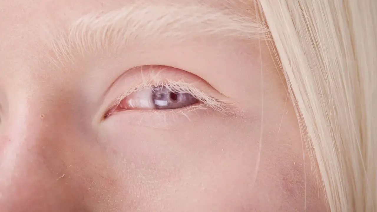Blond włosy i jasne brwi otaczają fioletowe oczy, świadczące o albinizmie.
