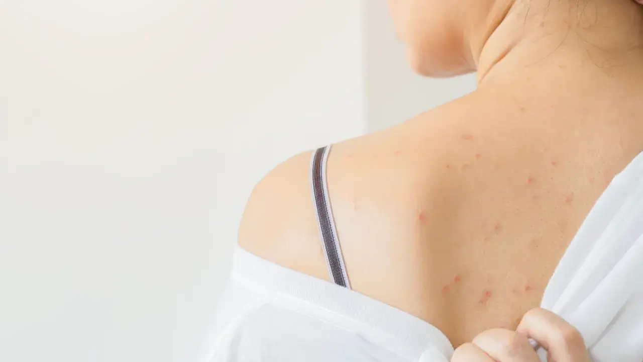 Schiena con eruzioni cutanee rosse, possibili segni di dermatite da sudore. Si cercano rimedi per alleviare il prurito e l'irritazione.