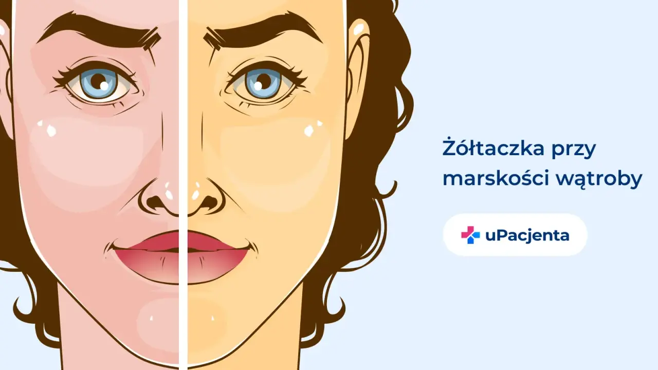Żółtaczka przy marskości wątroby, jeden z objawów alkoholowego zapalenia wątroby, powoduje zażółcenie skóry.