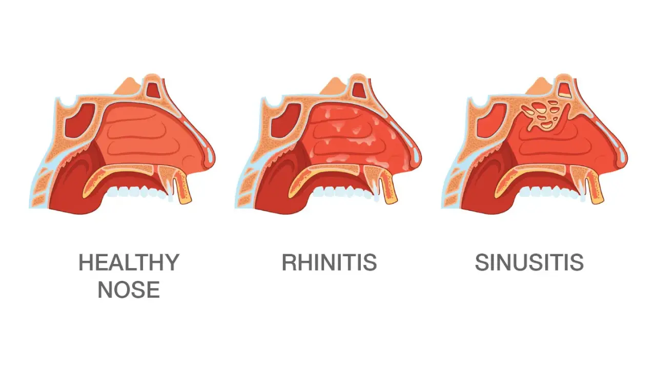 Przekroje nosa: zdrowy, z zapaleniem błony śluzowej (rhinitis) i z zapaleniem zatok (sinusitis). J30 kod choroby.