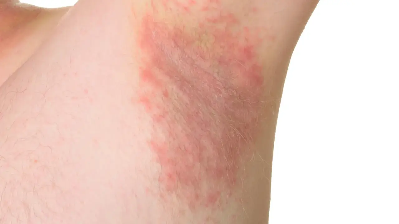 Irritazione cutanea sotto le ascelle, con chiazze rosse e sensazione di prurito sotto le ascelle senza rossore visibile.