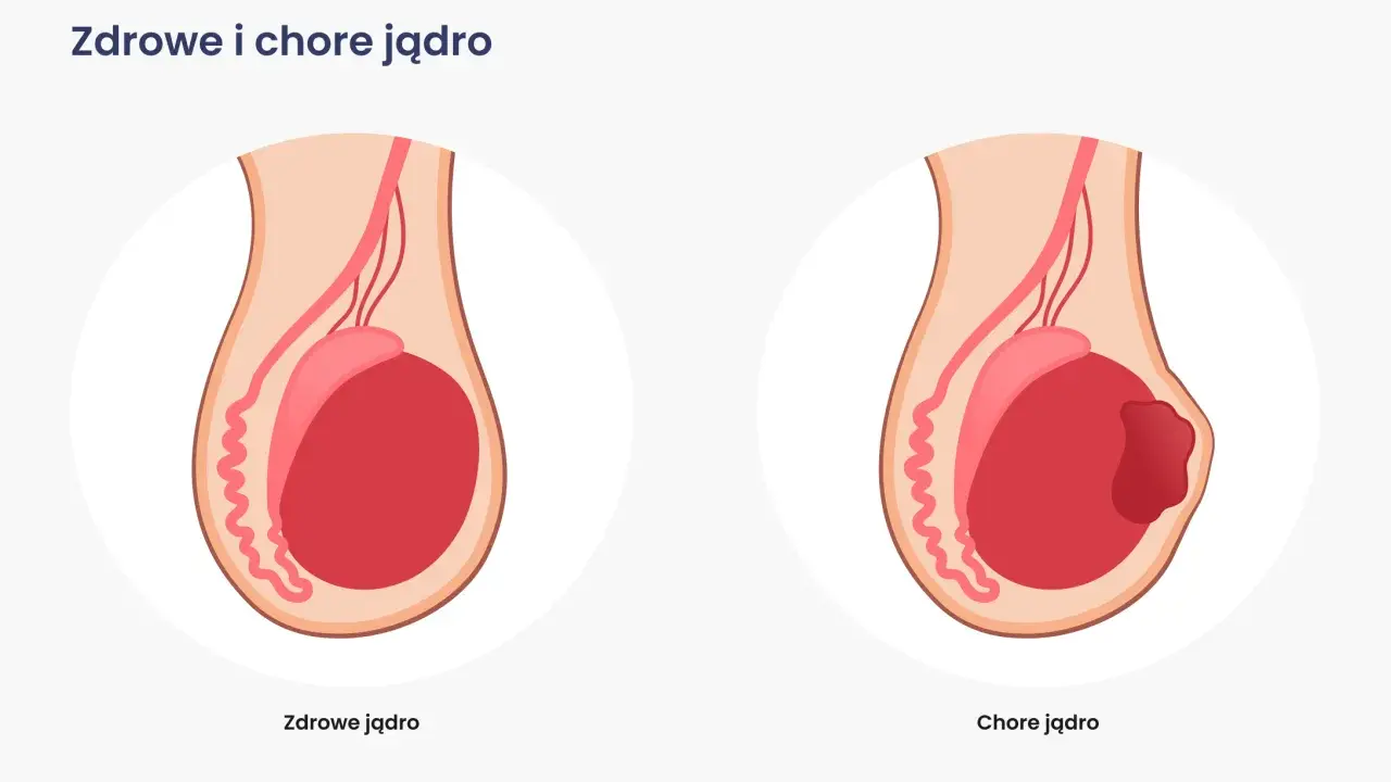 Ilustracja porównuje zdrowe jądro z chorym, na którym widoczny jest guz, wskazujący na raka moszny.