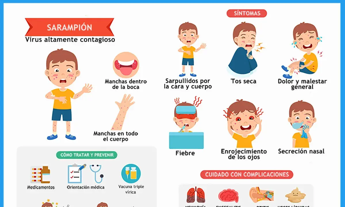 Ilustración sobre el brote de sarampión en niños, mostrando síntomas como sarpullidos, tos, fiebre y complicaciones.