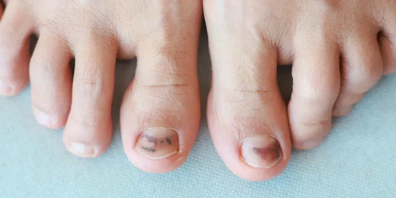 Gros plan sur des orteils, dont deux présentent une plaque de l'ongle abîmée avec des ecchymoses sombres, suggérant un traumatisme.