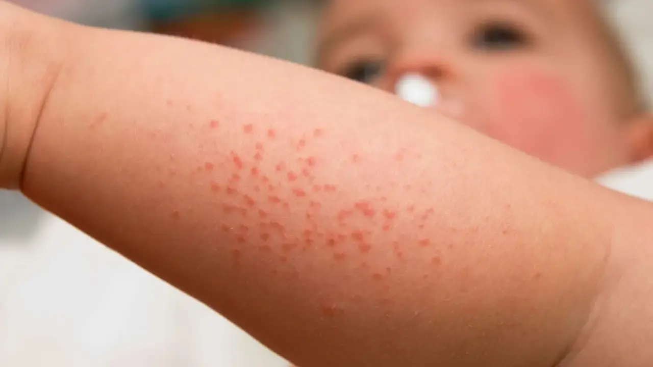 Bébé avec un bouton de chaleur sur le bras. Petits points rouges sur la peau.