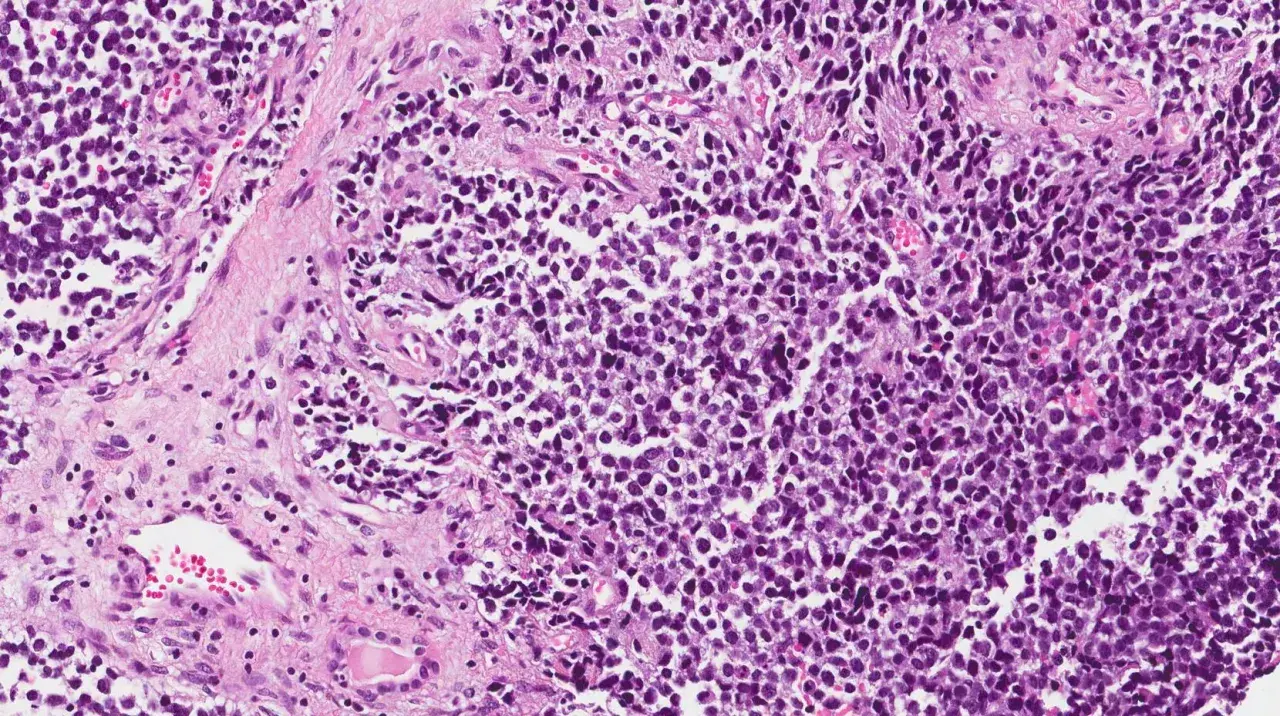 Microscopia di rabdomiosarcoma alveolare: cellule tumorali con nuclei scuri e citoplasma scarso, disposte in nidi separati da tessuto connettivo.
