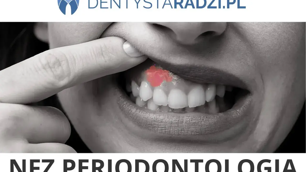 Zbliżenie na usta z widocznym zaczerwienieniem na dziąśle, sugerującym problem z paradontozą. Leczenie jest kluczowe.