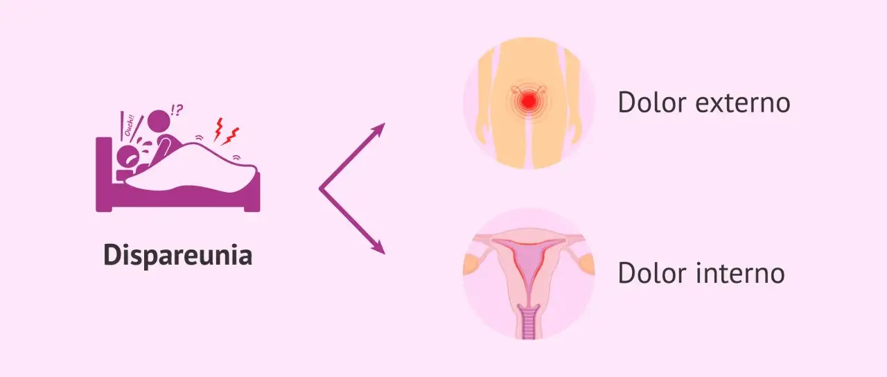 Dispareunia: dolor al ser penetrada, ya sea externo o interno.