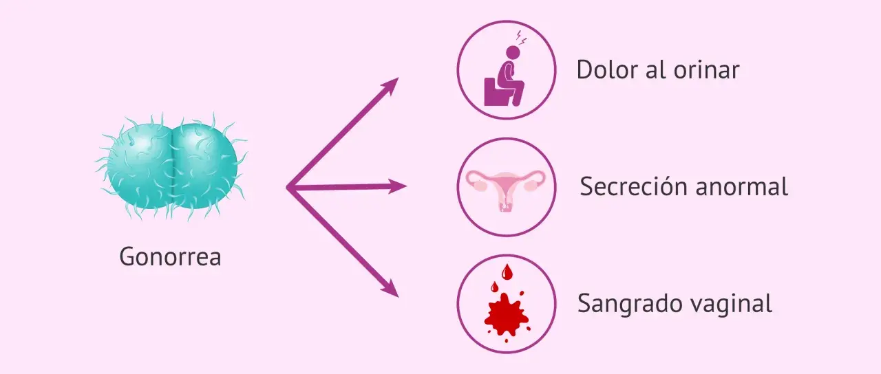 La gonorrea puede causar dolor al orinar, secreción anormal y sangrado vaginal.