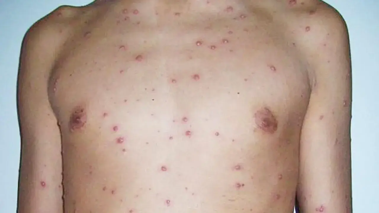 Torso y brazo de persona con granitos varicela leve, pequeños y rojizos, indicando una erupción cutánea.