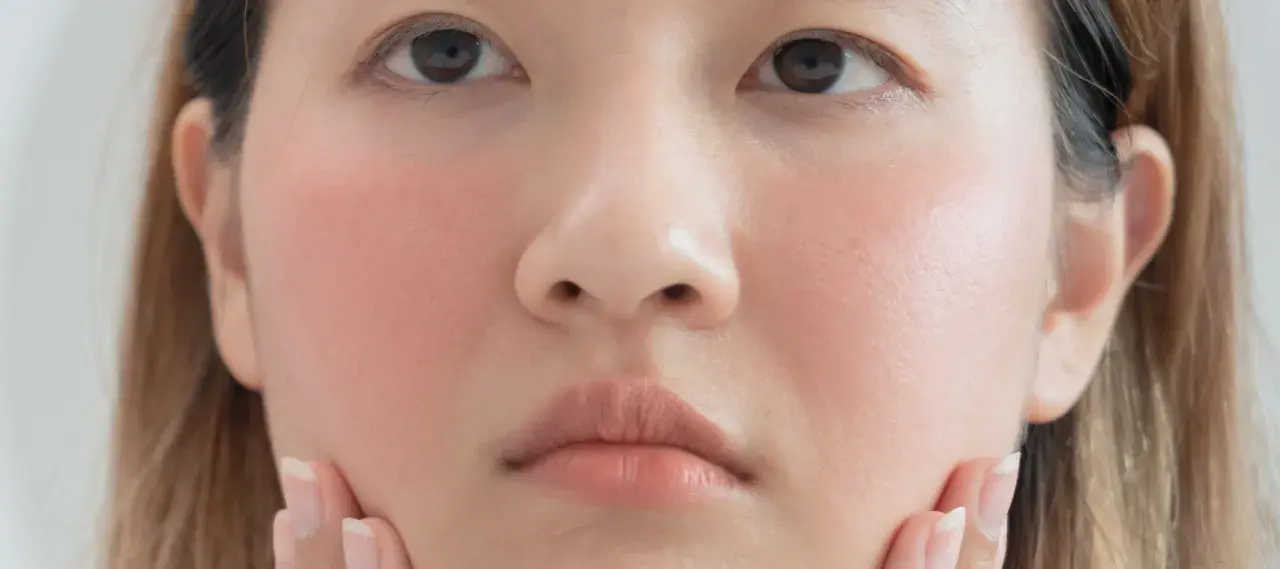 Gros plan sur le visage d'une jeune femme, ses joues rosées évoquant un doux **bouton soleil visage**. Ses mains effleurent délicatement sa peau.