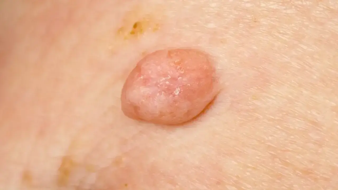Zmiana skórna, która może być jednym z objawów wirusa HPV. Widoczny różowy, lekko łuszczący się brodawczak.