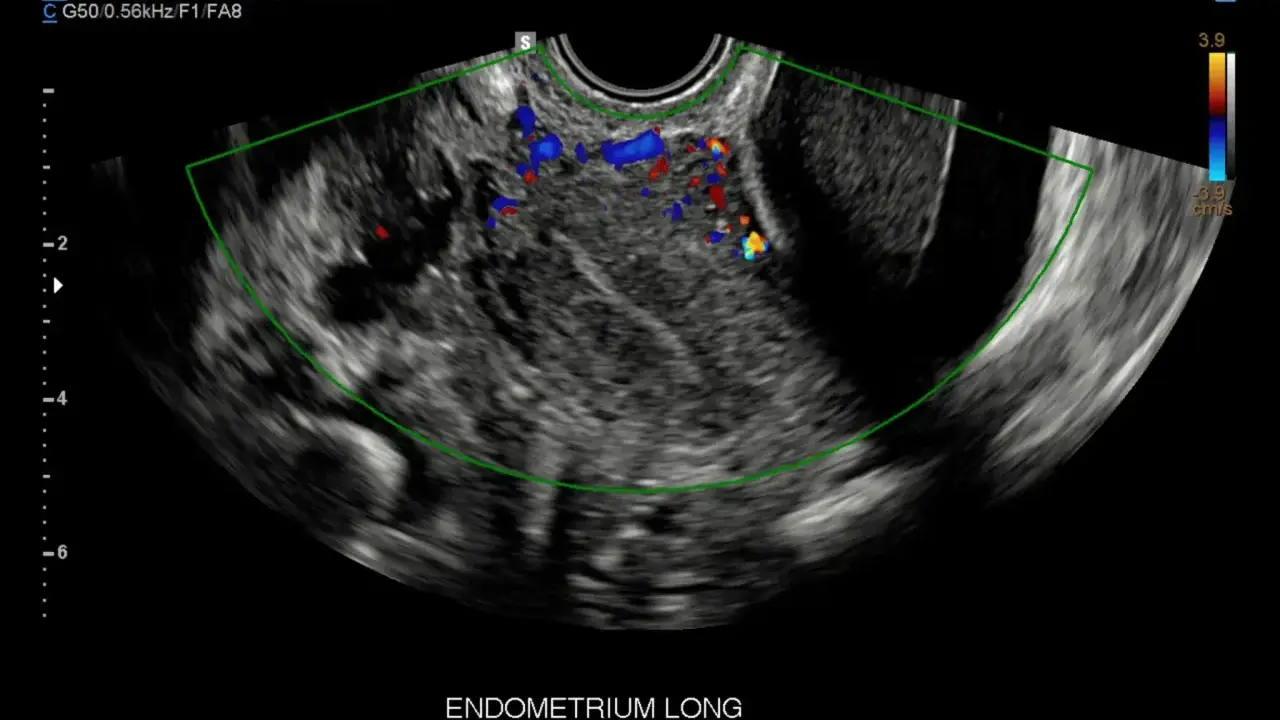 Ecografia pelvica con evidenza di vascolarizzazione anomala, possibile indicatore di tumore ovario.