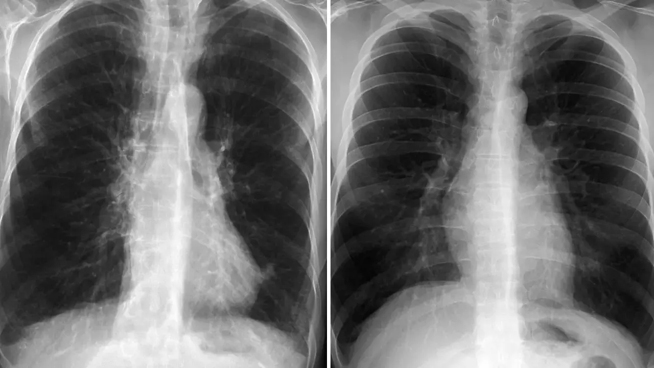 Zwei Röntgenaufnahmen des Brustkorbs zeigen Anzeichen von COPD. Ein rosa Puffer könnte zur Linderung der Symptome beitragen.
