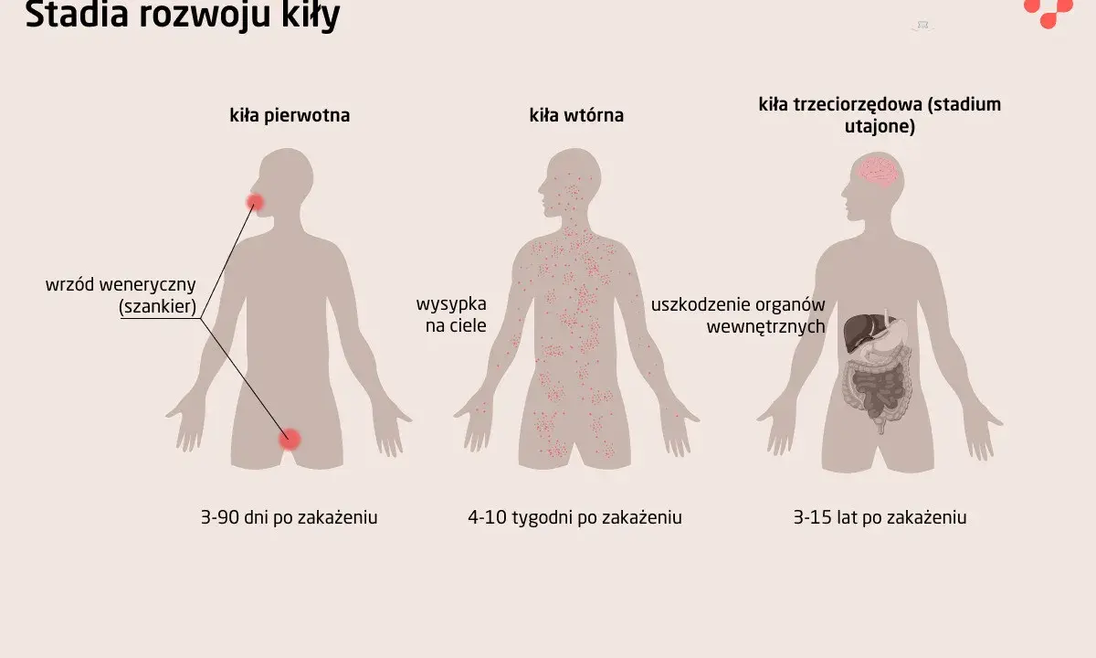 Ilustracja pokazuje stadia rozwoju kiły: pierwotna z wrzodem, wtórna z wysypką skórną, trzeciorzędowa z uszkodzeniem narządów.