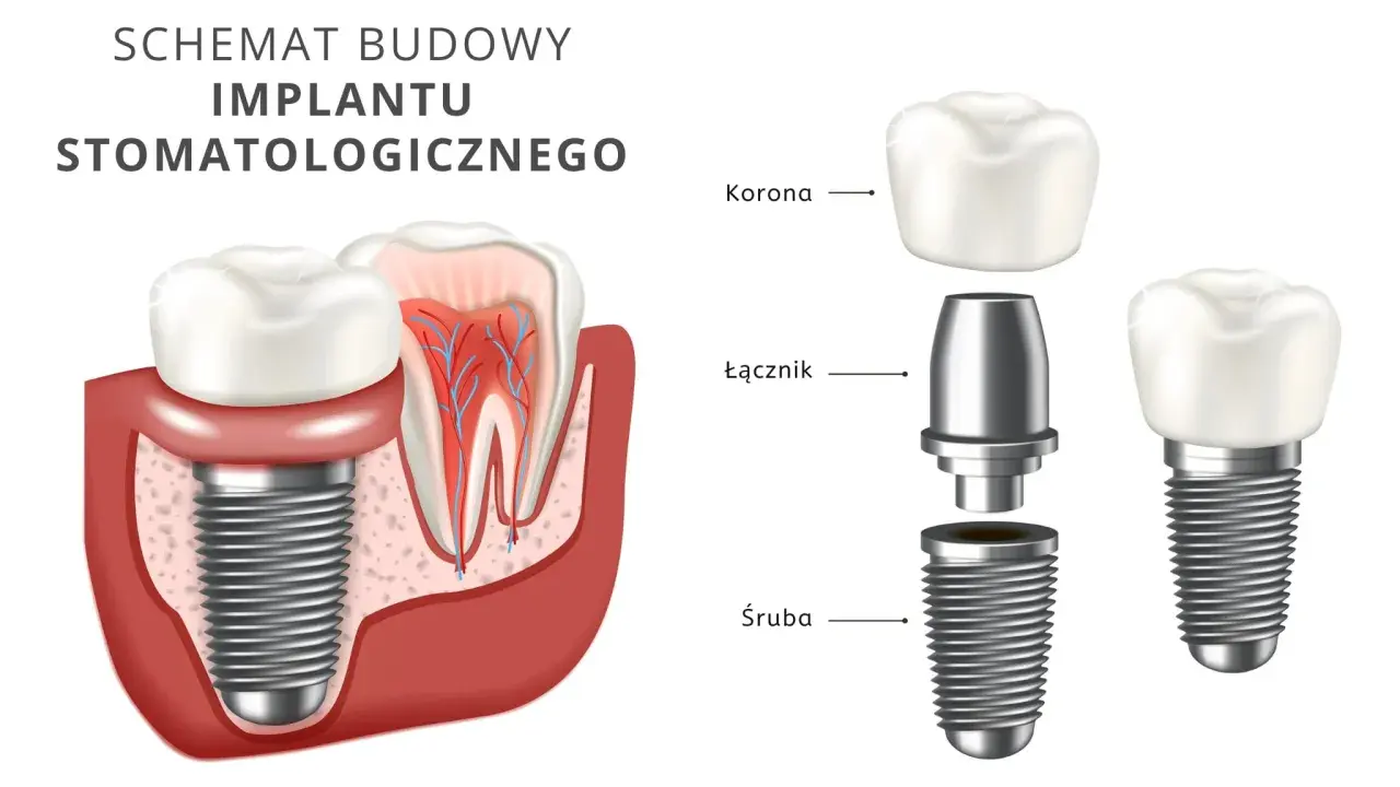 Schemat budowy implantu stomatologicznego. Dowiedz się, ile kosztuje wstawienie zęba i jak wygląda jego konstrukcja: śruba, łącznik i korona.