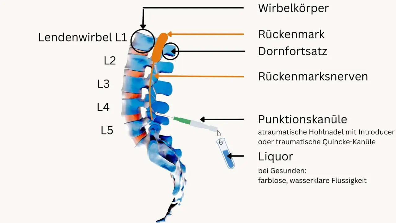 Illustration zeigt Lumbalpunktion mit Punktionskanüle im Bereich L4/L5. Mögliche Nervenreizung nach Lumbalpunktion wird durch die Nähe zum Rückenmark und den Nerven dargestellt.