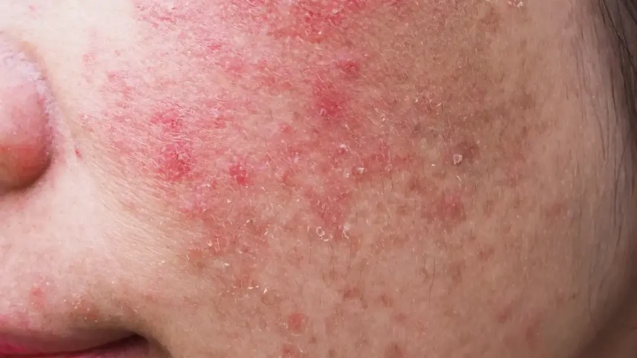 Gros plan sur une peau rougie et squameuse, signe d'une allergie cutanée au visage. Des plaques rouges et des petites pellicules sont visibles.