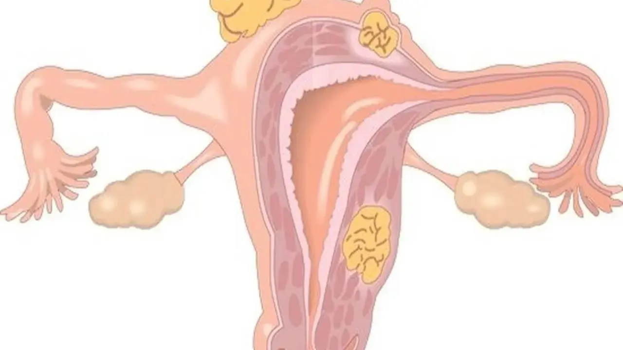 Anatomia kobieca z tyłozgięciem macicy i mięśniakami. Może wpływać na współżycie.