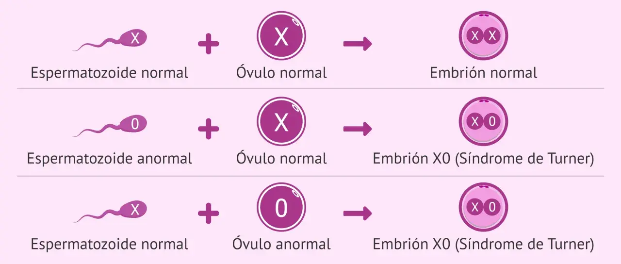Ilustración de la monosomía X. Muestra cómo un espermatozoide anormal (0) o un óvulo anormal (0) pueden resultar en un embrión X0, conocido como Síndrome de Turner.