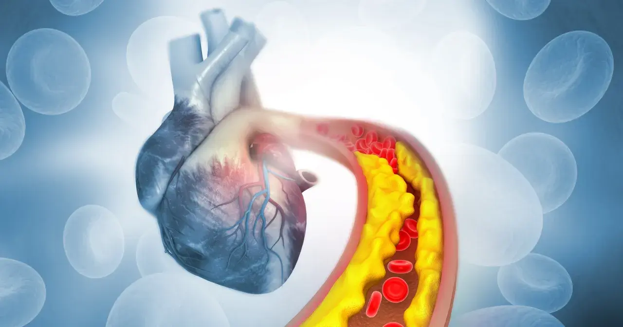 Serce z widocznym zatorami w naczyniach krwionośnych spowodowanymi przez zły cholesterol.