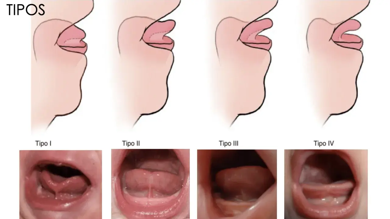 Ilustraciones y fotos muestran los tipos de anquiloglosia que es la limitación del movimiento de la lengua.
