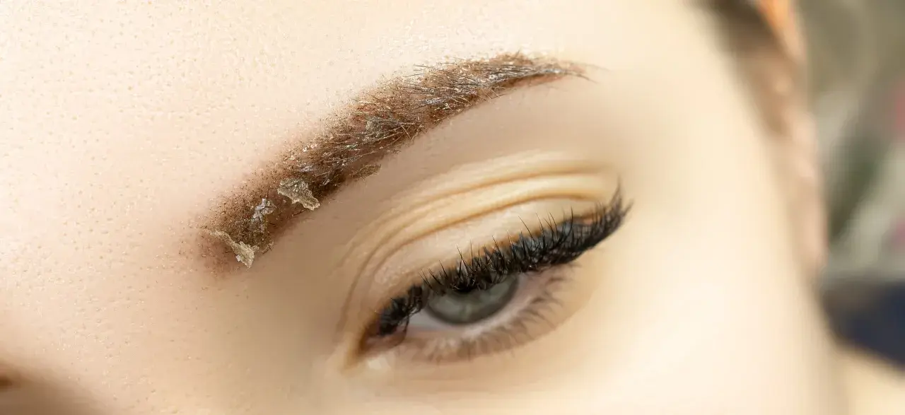 Gros plan sur un sourcil en cours de guérison après un maquillage permanent, montrant des croûtes et des poils. Soins après maquillage permanent sourcils.
