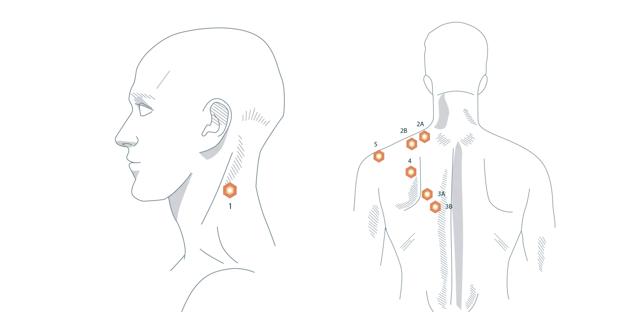 Illustration zeigt Triggerpunkte am Nacken und Rücken, die auf einen verspannten Trapezmuskel und dessen Ursache hinweisen.