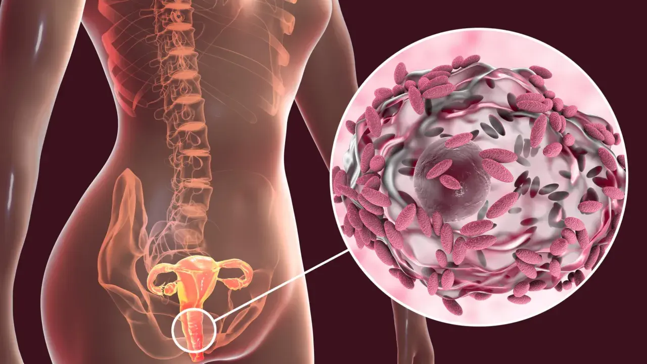 Anatomía femenina con detalle ampliado de vaginosis bacteriana.