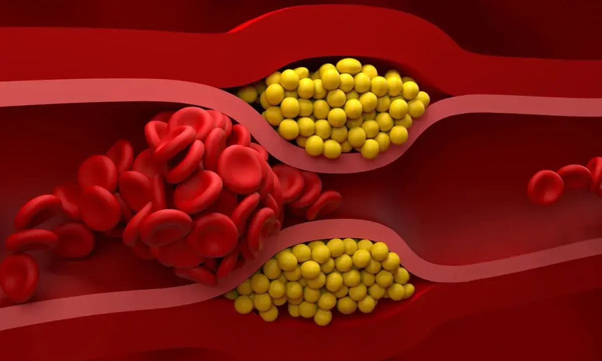 Zator w naczyniu krwionośnym: czerwone krwinki i żółte złogi cholesterolu nie-hdl blokują przepływ.