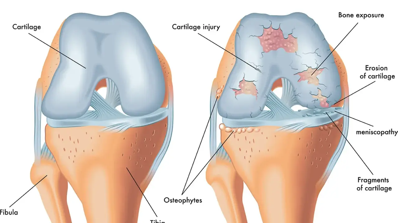 Vergleich eines gesunden Knies mit Arthrose. Arthrose zeigt Knorpelschäden, Knochenexposition und Osteophyten, was zu steifen Gelenken führt.