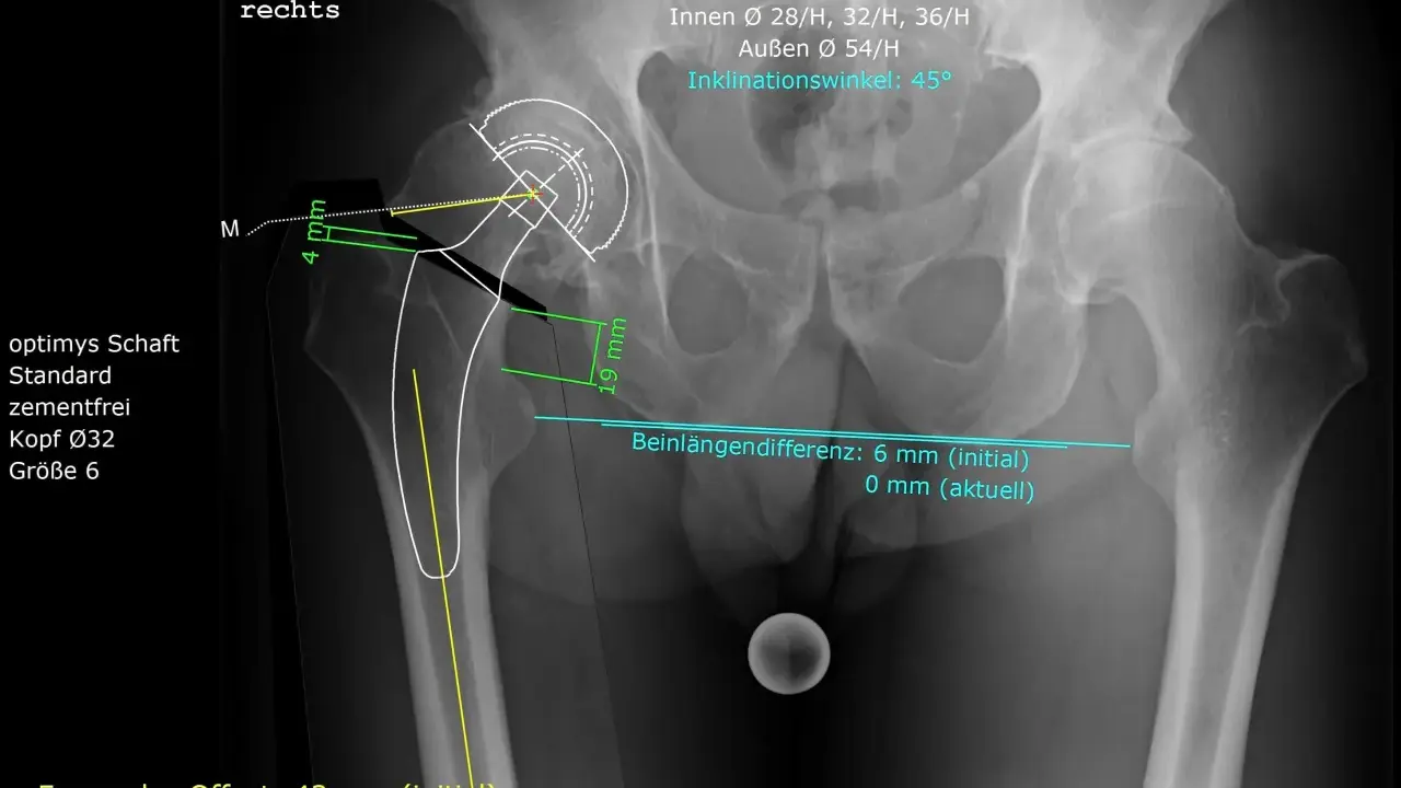 Röntgenbild des rechten Hüftgelenks mit Markierungen zur Beurteilung der coxarthrose stadien und der Beinlänge.