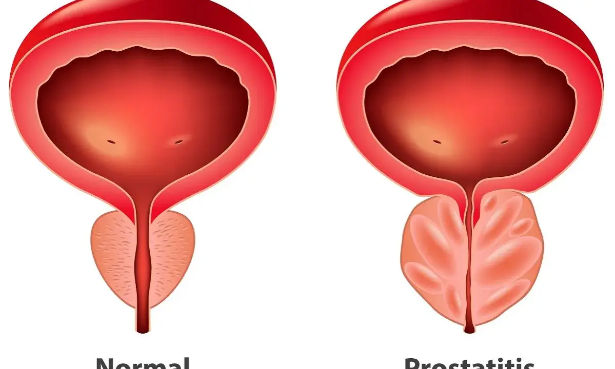 Porównanie: prawidłowa prostata i przerost gruczołu krokowego. Widoczny powiększony gruczoł krokowy uciska cewkę moczową.