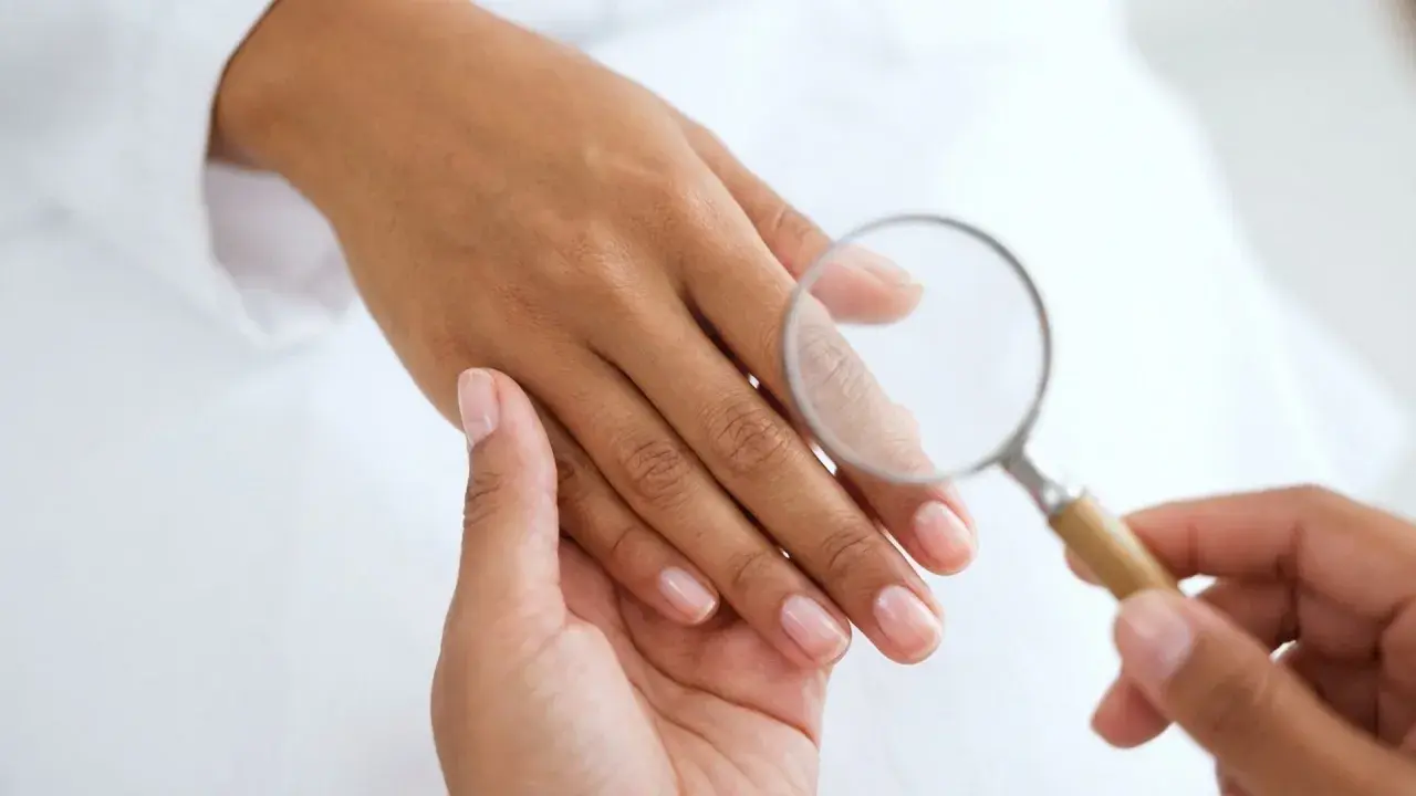 Esame ravvicinato di un'unghia con lente d'ingrandimento, per escludere infezioni come la pseudomonas unghia.