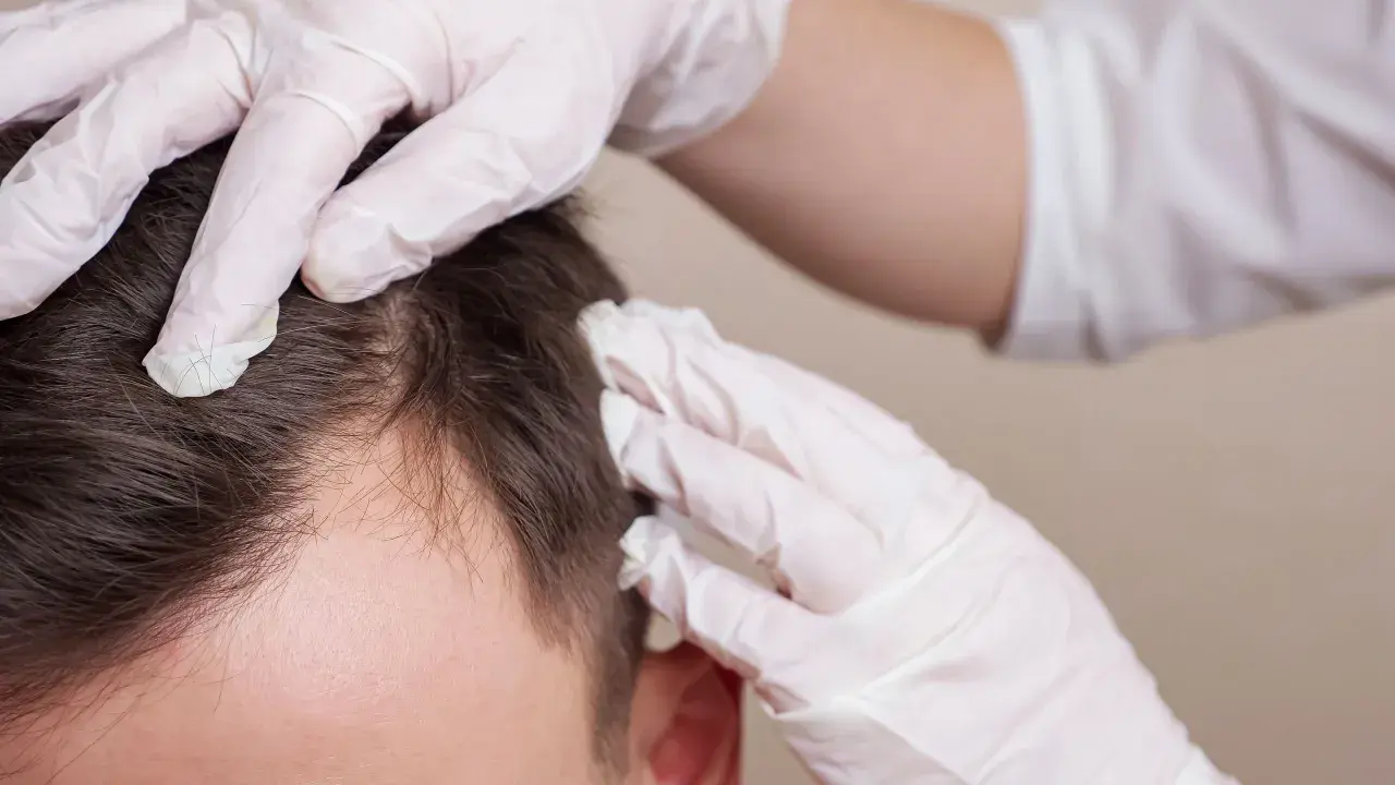 Hände in weißen Handschuhen untersuchen die Kopfhaut eines Mannes, um Haarausfall zu verhindern.
